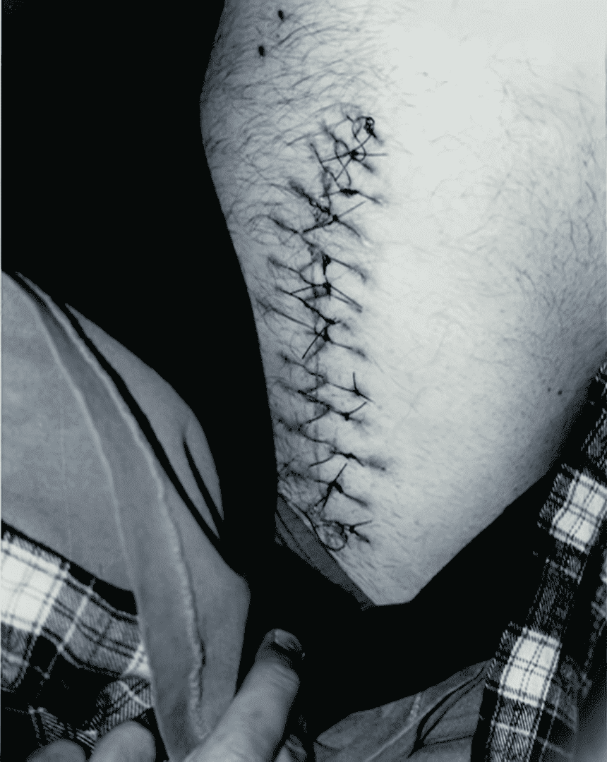 Photo des 11 points de suture sur la cuisse de Steven Bradbury suite à l'incident de Montréal